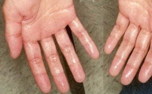 Chữa ra mồ hôi tay chân như thế nào?