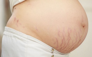 Chữa rạn da sau sinh bằng nguyên liệu tự nhiên