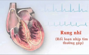 Phòng ngừa đột quỵ do rung nhĩ