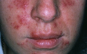 Trị bệnh mẩn đỏ có mủ rosacea như thế nào?