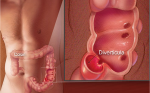Bệnh túi thừa đại tràng có nguy hiểm không?