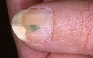 Thuốc tím có trị được nấm móng chân?