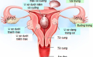 U xơ tử cung có cần kiêng uống sữa đậu nành không?