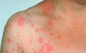 Điều trị zona thần kinh ở người lớn tuổi như thế nào?