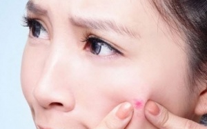 Mụn trứng cá nổi đầy mặt, có cách nào trị mụn hiệu quả?