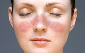 Kháng thể lupus trong máu có phải là dấu hiệu bị mắc bệnh lupus?