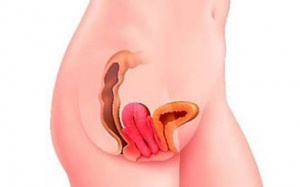 Viêm xương khớp có gây thoát vị âm đạo?