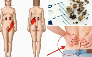 Thường xuyên buồn tiểu, vã mồ hôi: Coi chừng sỏi thận