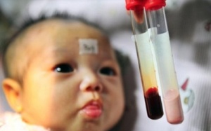 Tan máu bẩm sinh bị nhầm thành... ghẻ, tắc ống mật