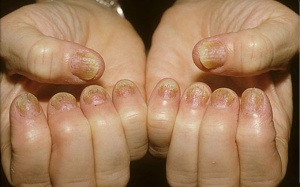 Vẩy nến thể móng và phương pháp điều trị