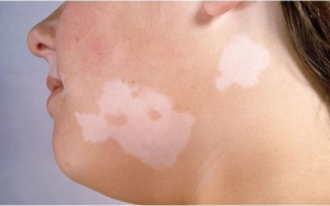 Nên làm gì để tránh bệnh lang ben tái phát?