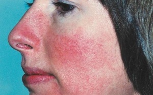 Tác hại khó lường khi bổ sung vitamin B12 quá liều