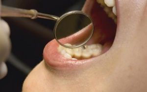 Viêm lợi làm tăng nguy cơ ung thư vú