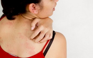 Mề đay gãi bật máu cũng không hết ngứa, chữa trị bằng cách nào?