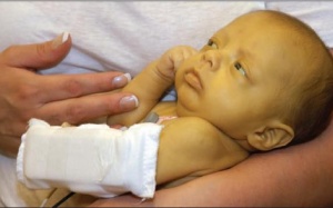 Trẻ viêm gan C dễ bị ung thư gan, xơ gan