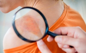 Những bệnh tự miễn gây tổn thương ngoài da