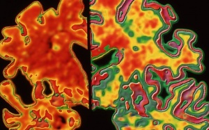 Vai trò của hình ảnh protein amyloid trong não đối với bệnh nhân Alzheimer