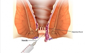 Điều trị ngứa hậu môn bằng cách nào?