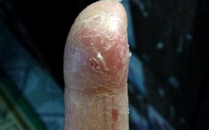 Bong da ngón tay sau sinh là bệnh gì?