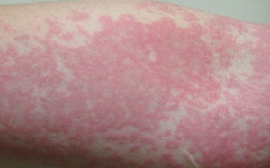 Sự khác biệt của bệnh nổi mề đay và phát ban nhiệt