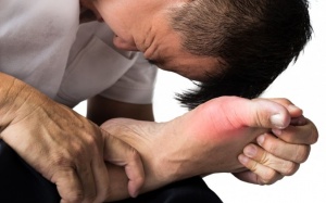 Bệnh gout làm tăng nguy cơ rung nhĩ