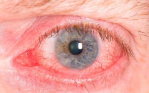 Đỏ mắt mạn tính, phải làm sao?