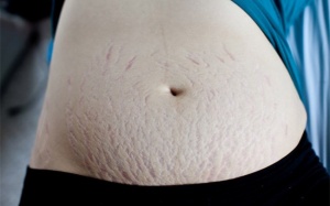 6 cách chữa rạn da bằng nguyên liệu tự nhiên