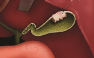 Bị polyp túi mật dùng TPCN Kim Đởm Khang có hiệu quả không?