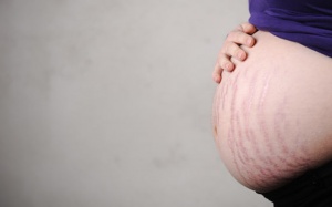 4 cách trị rạn da sau sinh đơn giản mà hiệu quả