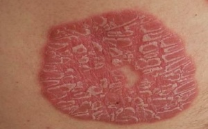 Bệnh vẩy nến và những điều ít được biết tới