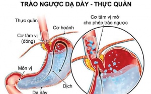 Trào ngược dạ dày thực quản trị mãi không khỏi