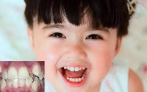 Răng trẻ mọc lệch, làm thế nào để tránh?