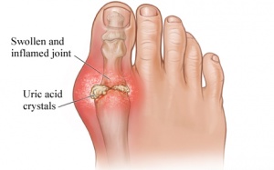 Cách làm thức uống giúp giảm đau do bệnh gout