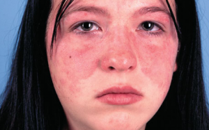 Những yếu tố môi trường hiện đại gây bệnh tự miễn