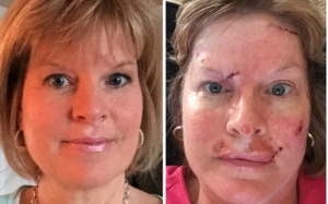 Ung thư da hủy hoại con người như thế nào?