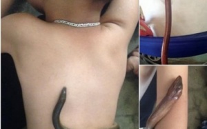 Có nên hạ sốt cho trẻ bằng lươn sống?