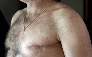 Ai quan tâm đến đàn ông ung thư vú?