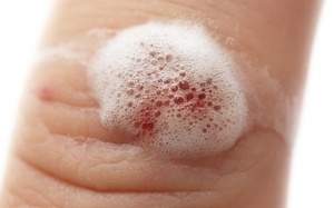 Tại sao không nên dùng nước oxy già để rửa vết thương?