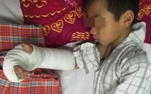 Ghép nối cánh tay gần đứt lìa cho bé 8 tuổi