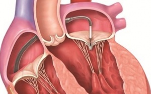 Hở van tim 2 lá 1/4 điều trị ra sao?