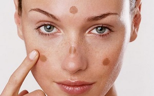 Làm sao để phòng tránh và điều trị nám hiệu quả?