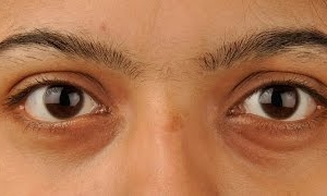 Khi “cửa sổ tâm hồn” bị ảnh hưởng bởi cường giáp