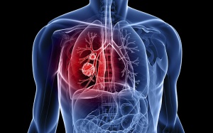 Thuốc mới trị bệnh ung thư phổi hiếm gặp 