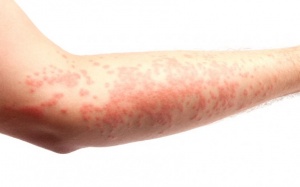 Ngứa điên cuồng do bị chàm, phải làm sao?