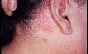 Mắc bệnh vẩy nến dễ bị loãng xương