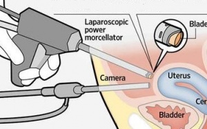 Phẫu thuật u xơ tử cung bằng morcellator có an toàn?