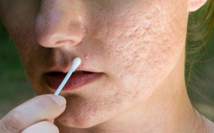 Rỗ mặt vì chẳng biết gì về trị mụn bằng tinh dầu