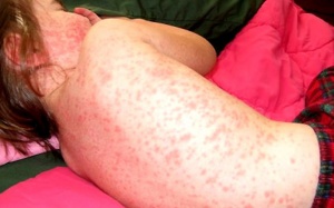 Nhận biết và xử lý sốt xuất huyết cho trẻ