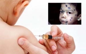 Con tôi đã tiêm vaccine sao vẫn bị thủy đậu?