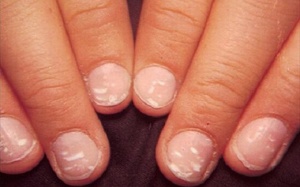 Móng tay có đốm trắng như hạt gạo là bệnh gì?